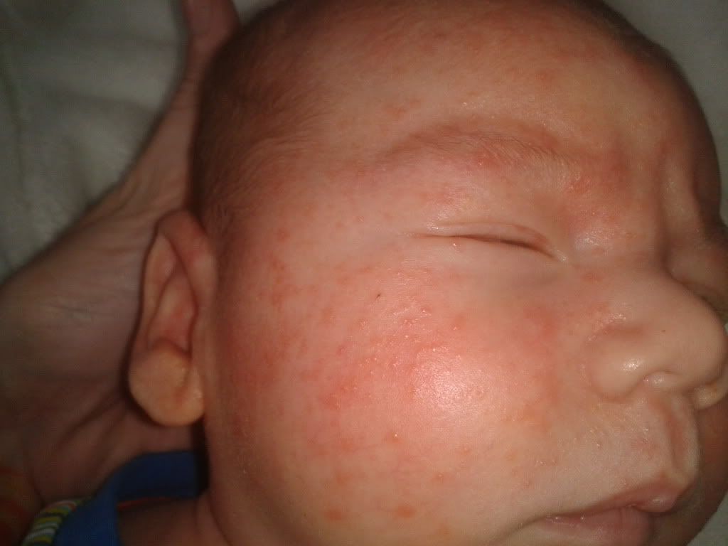 Red spots on baby's face nhs jobs, top 50 youtube videos 2014, red